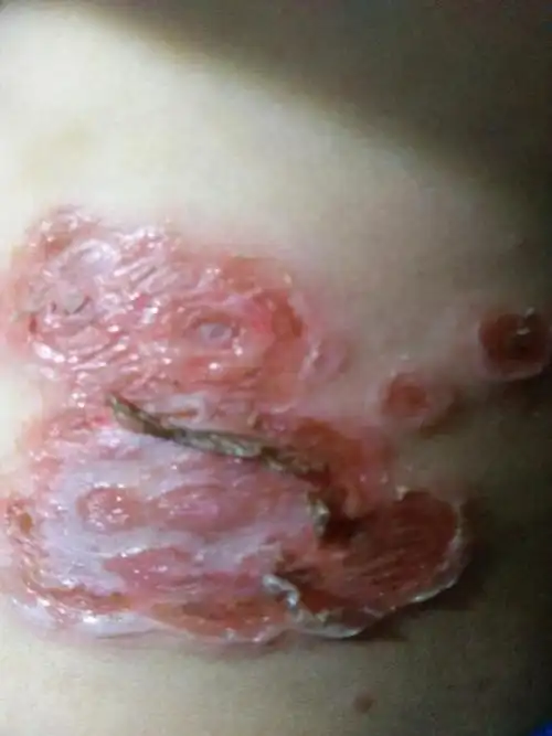 请问我弟弟生什么了?怎么皮肤溃烂了?