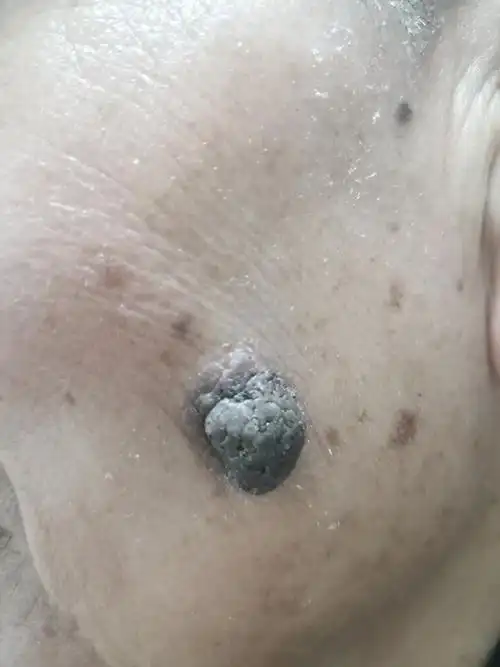 形形色色的脂溢性角化病_老年斑_介绍_症状表现_治疗方式 - 好大夫