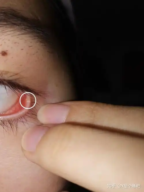 眼睑长颗粒 - 知乎