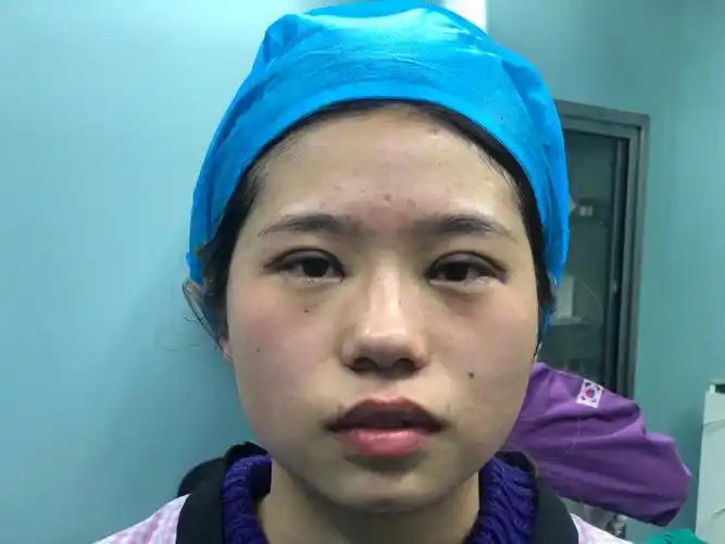 多项-全切双眼皮术后即刻效果】做双眼皮整个人过_圈子-新氧美容整形