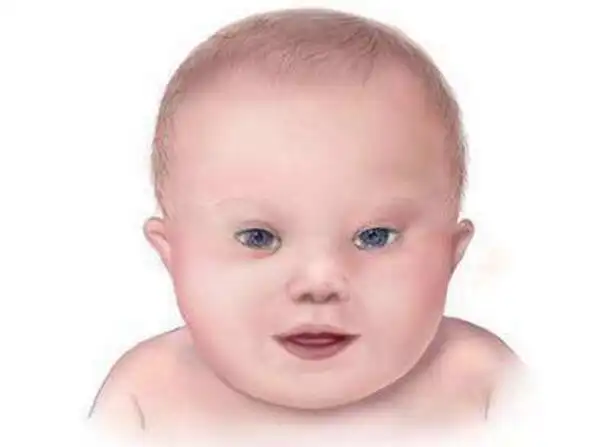 唐氏综合征的终结者美国第三代试管婴儿