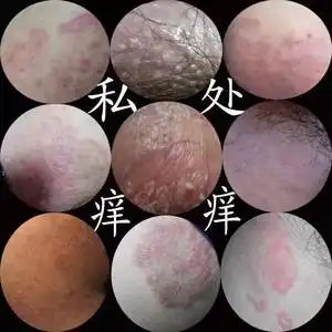 外阴下体膏炎瘙痒私处下面痒阴毛毛囊男女专用止痒抑菌外用药白斑