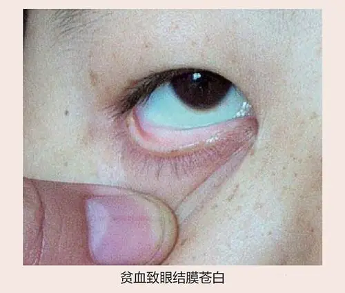 手和脚的甲床,当血量不足,这些地方就会变为白色,是贫血的明显信号