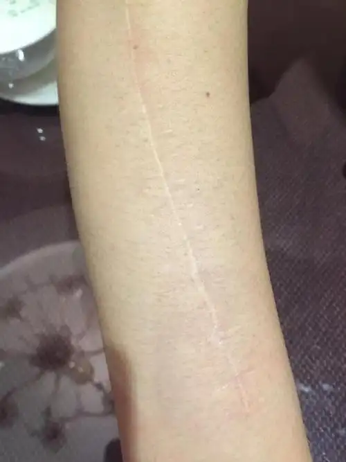 曹璐遭黑衣人殴打后胳膊上留下的伤痕.