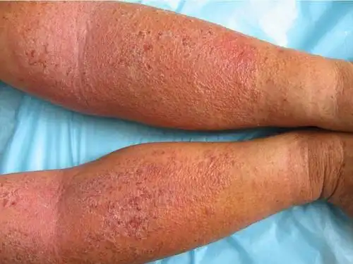 预防湿疹的措施是怎样的