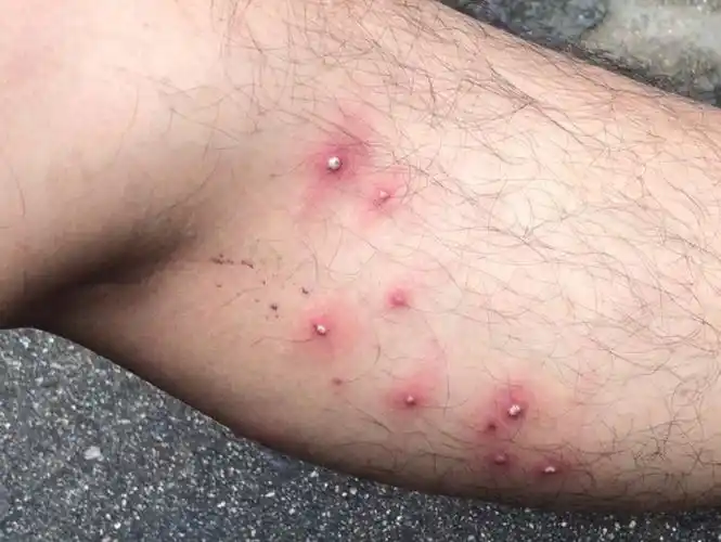 毛囊炎是否都是细菌感染所致,当然不是,许多原因可以引起"毛囊发炎"