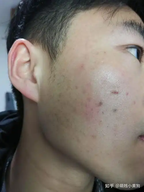 光子嫩肤去痘印记录