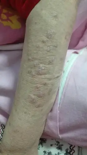 老人身上起的 特别痒 应该是一些药吃的 大家帮忙看下 有一天给老人喷