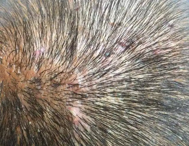 头皮上的"小疙瘩"是怎么回事?对我们的身体健康会造成影响吗?