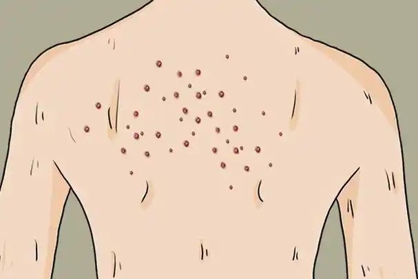 有可能是毛囊炎和青春痘,教你如何预防