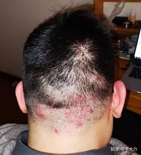 头皮上的毛囊炎一般如何治疗(头皮长毛囊炎怎么办)