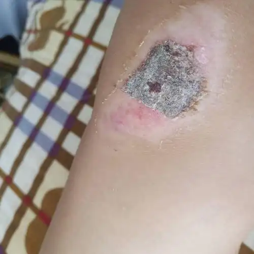 伤口结痂脱落后发红