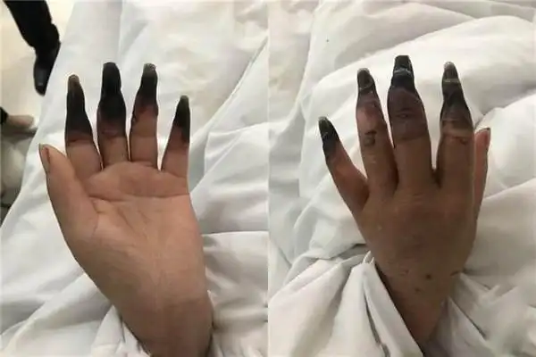 女子厨房收拾荤菜弄伤手指,8根指头逐渐坏死,变得焦枯发黑