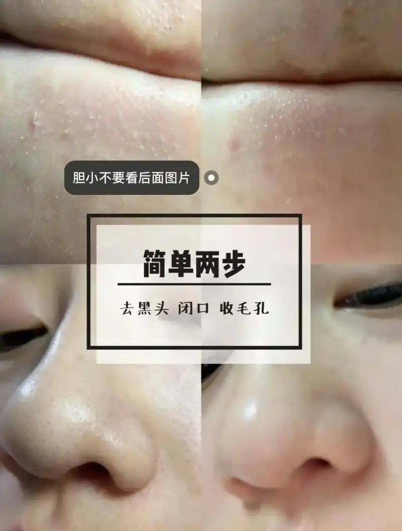 黑头白头都掏空!为什么毛孔粗大,草莓鼻,白头, - 抖音