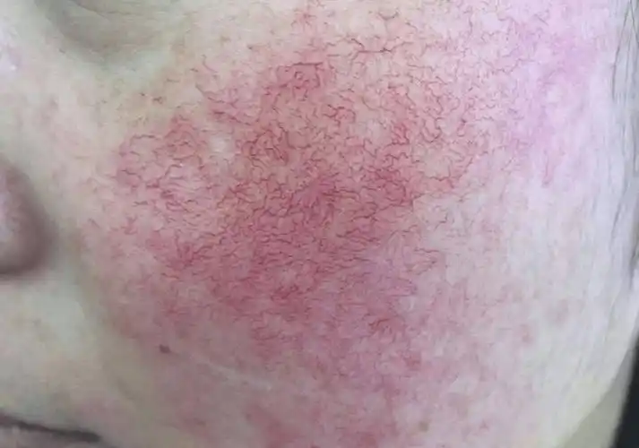 红血丝满脸都是,接下来和大家分享一下,脸上的红血丝如何消除?