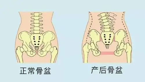 享生宝产后骨盆如何恢复