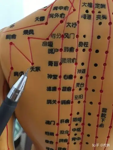 拔罐调理病症之落枕