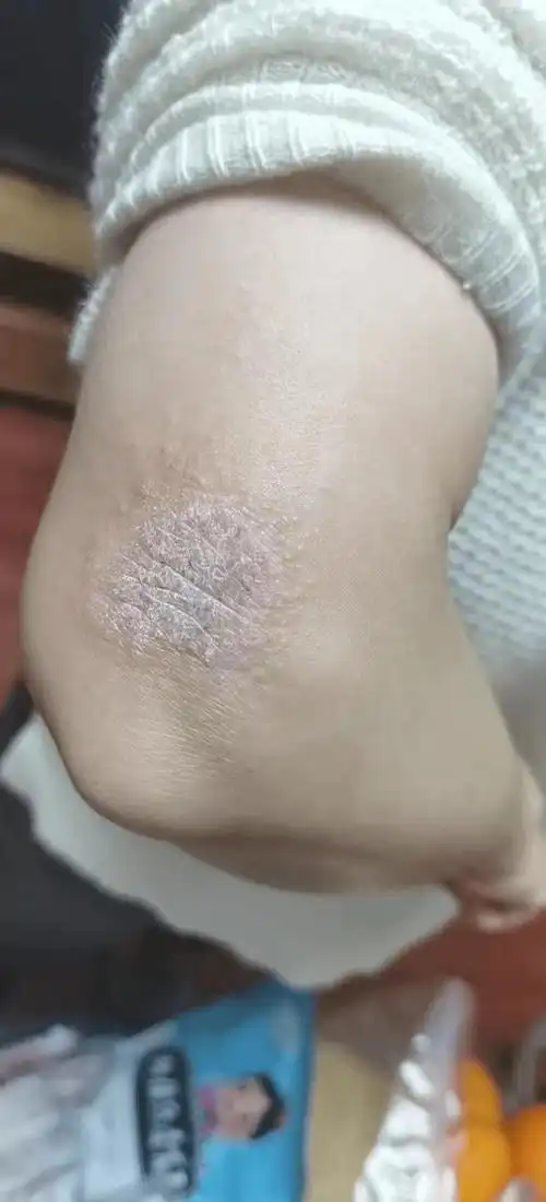 箹诗工坊干性湿疹手肘部位发痒