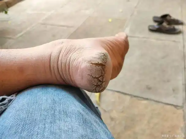 不是冬天脚也开裂是什么情况