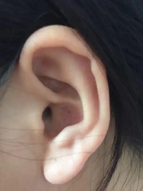 诊断标准,通常认为耳垂部分大得与耳廓不成比例或不协调即为耳垂肥大