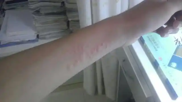 04荨麻疹是春季常见的过敏性皮肤病,日常生活中怎样预防荨麻疹呢1