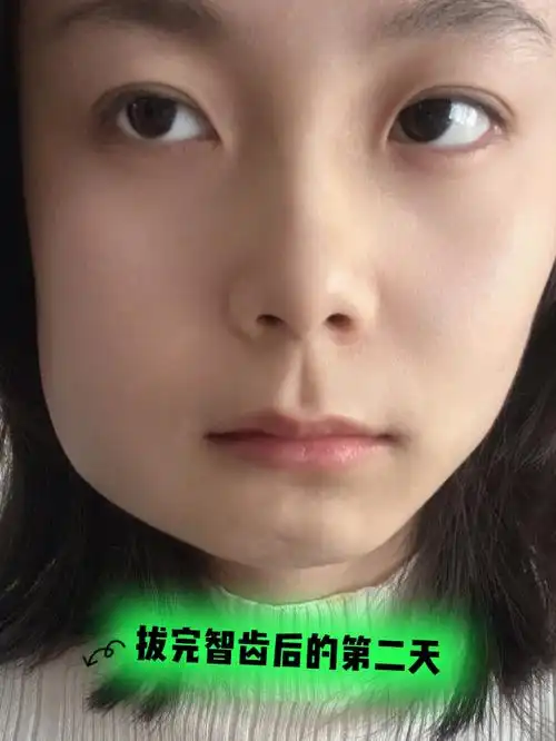 拔完智齿后第二天