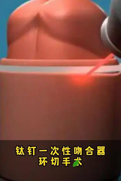 钛钉一次性吻合器环切手术
