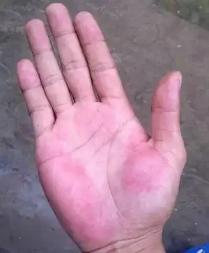 手掌变成这样颜色竟是血癌早期