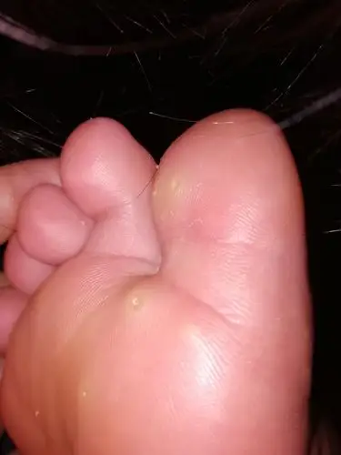 脚起泡,但挑破了又没水,之后就很痛,有时候也会痒,怎么回事