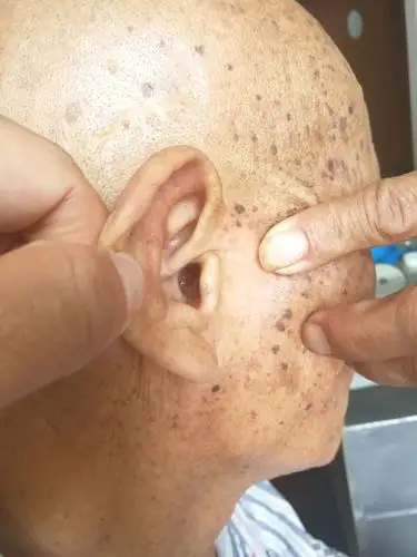 赣州市立医院独立完成一例外耳道恶性肿瘤根治手术.