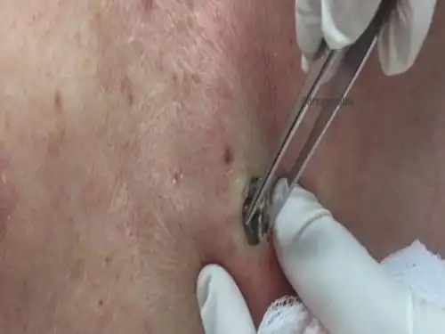 硬得像石头的超巨大黑头粉刺,不申请金氏世界纪录太可惜了!