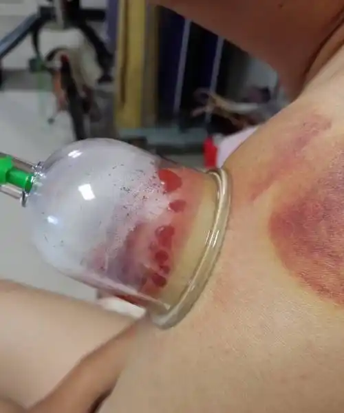 入伏养生:拔出湿气治肩周炎