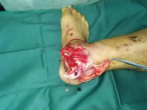 煤矿作业不慎 重物砸断右腿神经 小伙险断肢