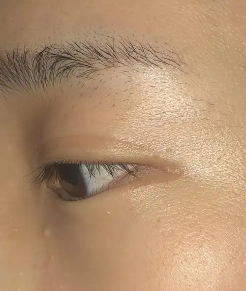 我的下眼睑是不是有点问题