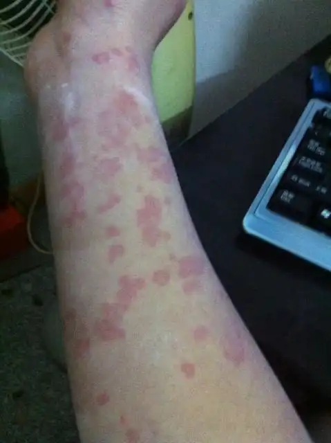 请大虾看看这种是什么过敏症状