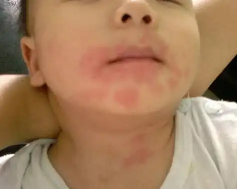 儿童过敏症状儿童过敏症状及图片