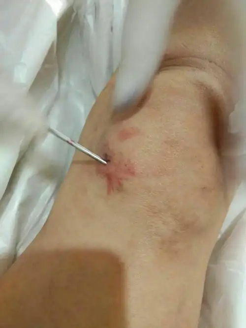 膝关节积液为何总是抽不尽