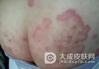 体癣的传染方式是什么