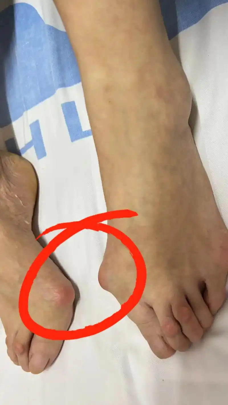 大脚骨手术术后照片,手术非常成功#大脚骨 #门诊 #矫形 - 抖音