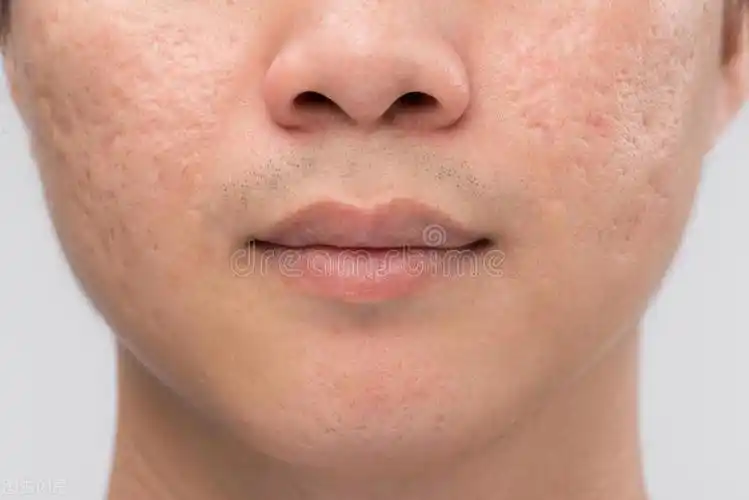 男士皮肤粗糙暗沉毛孔大怎么改善(解决你毛孔粗大问题的窍门)