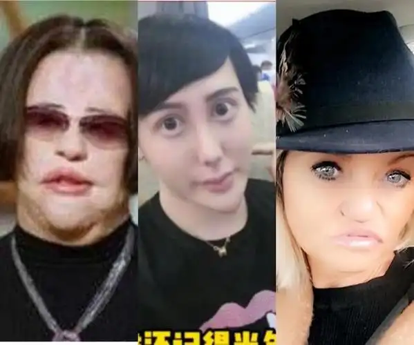 整容变毁容:网红百万整成女鬼,女星头顶整出大洞,简直惨不忍睹