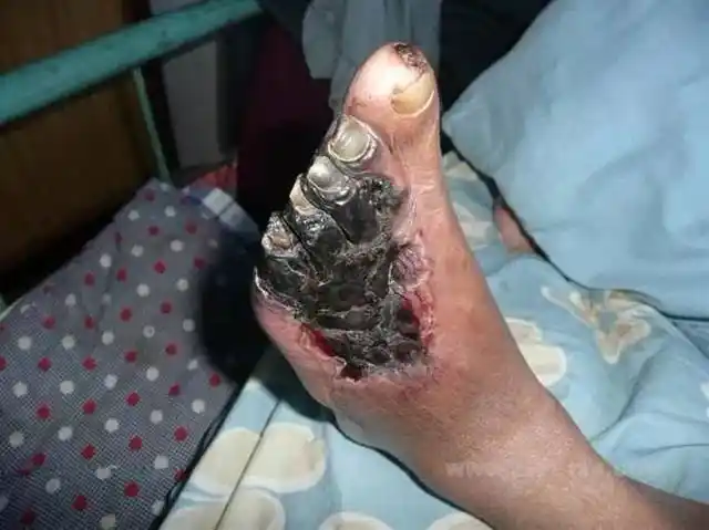 直播预告从血糖高到糖尿病足您离这个可导致截肢的恐怖并发症到底有