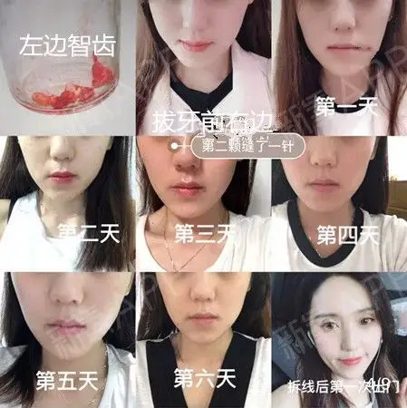 拔智齿的脸型变化图解_拔智齿的脸型变化图