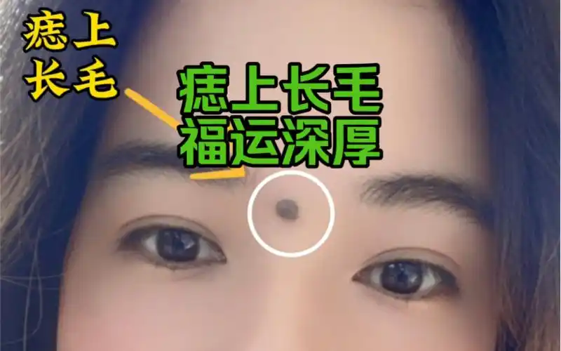 痣上长毛,福运深厚之相!