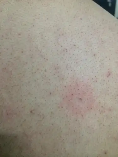 背后长了好多红点又不痛不痒的 有好几年了吧