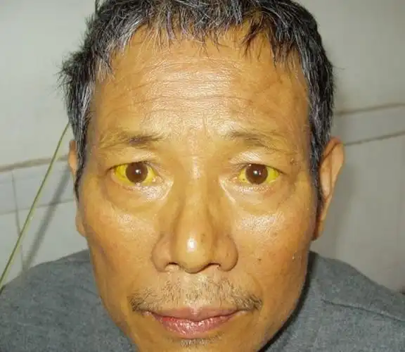 皮肤黄出现"1苦2黄",八成是肝癌细胞已