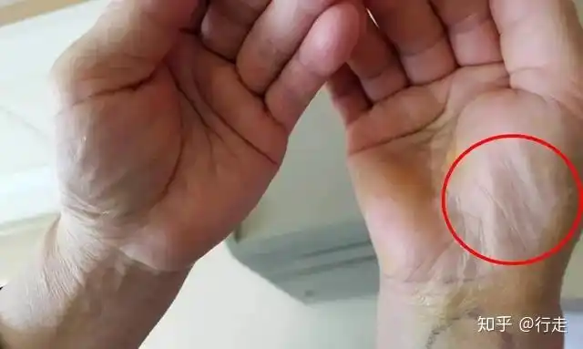 手部出现4个变化是大病来临的信号千万别忽视晚了医生都无奈