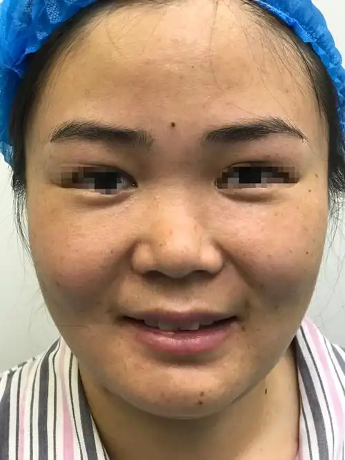 鼻翼软骨发育过大,有力针对于原因1,鼻头皮肤肥厚所致的鼻头肥大,鼻头