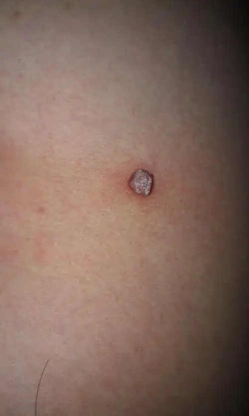 内侧一个黑色的小痣被我用手弄破以后现在长出了个3到4毫米的小肉瘤