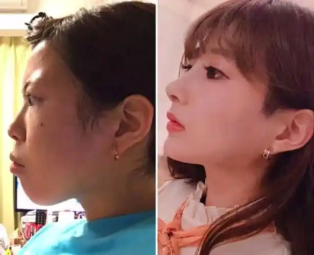 说一个整形成功的夸张案例 | 日本整容整形